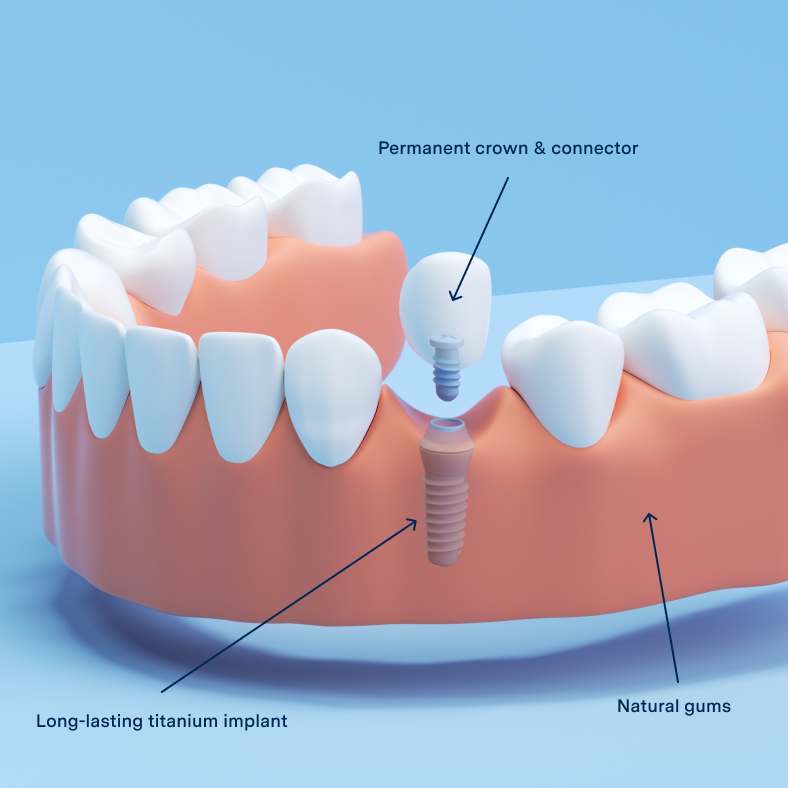 Dental Implant Process at Aspen Dental.