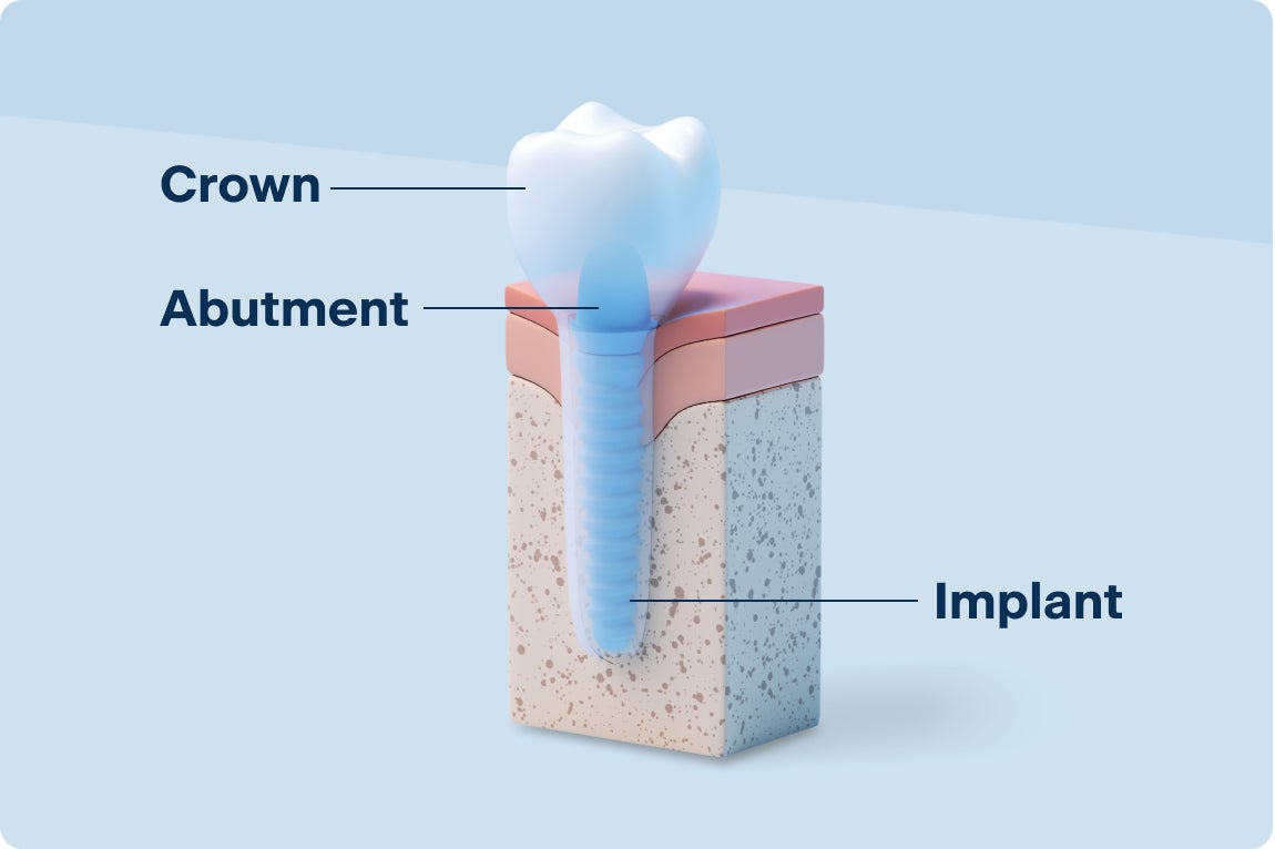 A diagram of a dental implant showing the three main components: the crown, abutment, and implant. The crown sits on top, attached to the abutment, which connects the implant embedded in the jawbone. The image provides a clear visual explanation of dental implant structure.