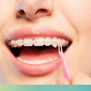 Close-up of ceramic braces, offering a less noticeable orthodontic treatment option for teens and adults.