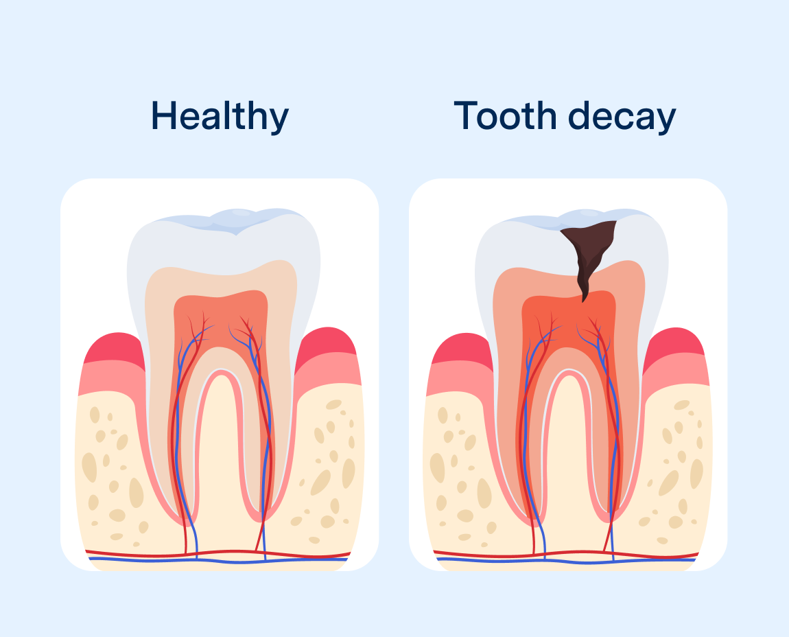 Graphic comparing a healthy tooth and one with decay, showing structu