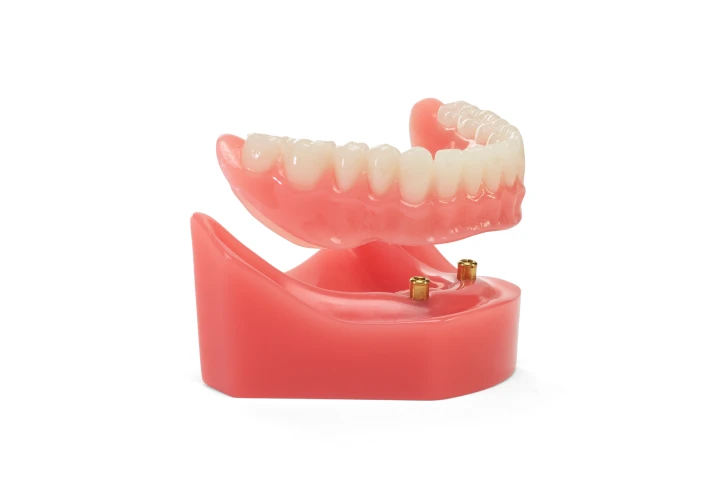 Open set of dentures with two titanium implants on gum base, labeled 'New for you', against a white background.