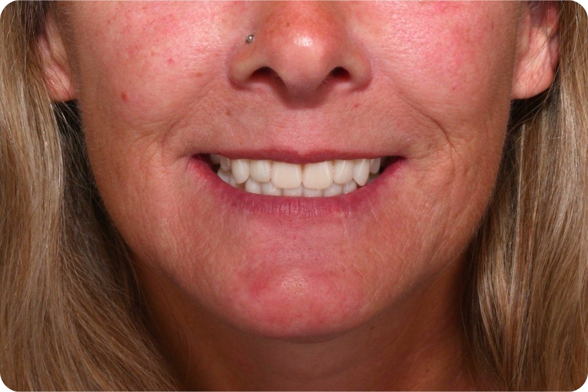 Close-up of a woman smiling, showing naturally prominent canine teeth that resemble vampire fangs; highlights realistic inspiration for fang tooth modifications.