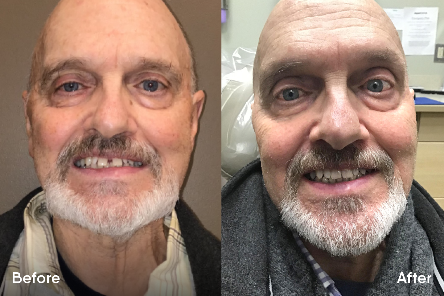 Before and After Motto Clear Aligners Reviews Aspen Dental