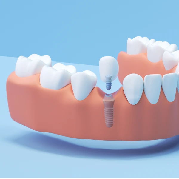 A 3D image of an Aspen Dental single tooth implant. 