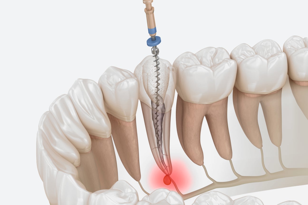  Illustration of a dental procedure showing a drill being used to treat an infected root canal in a molar, highlighted by a red area at the base of the tooth.