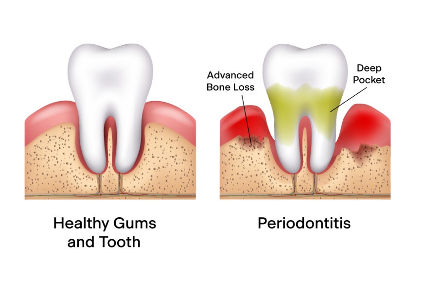 Comparing healthy gums and teeth with a case of periodontitis, showing the differences in gum health, bone loss, and deep pockets.