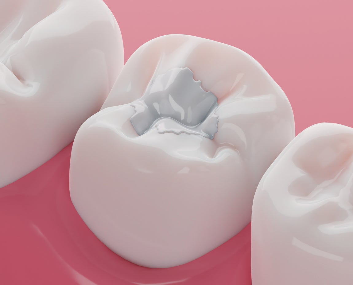 A close-up of a tooth with a labeled ceramic filling between two molars. Demonstrates a detailed visual of restorative dental procedures.