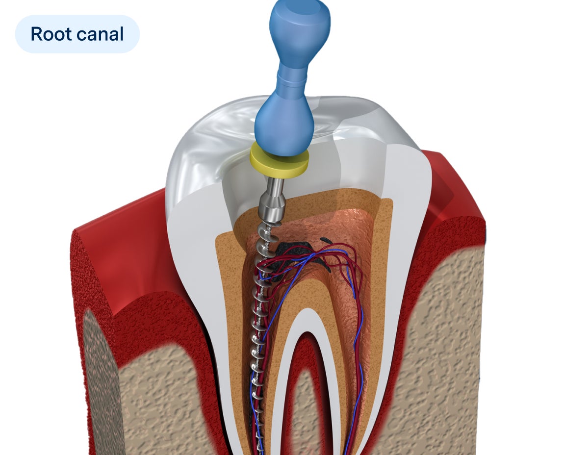 Illustration of two teeth showing different types of dental fillings, one with a white composite filling and the other with a silver amalgam filling, labeled with "Dental filling" in a dental treatment context.