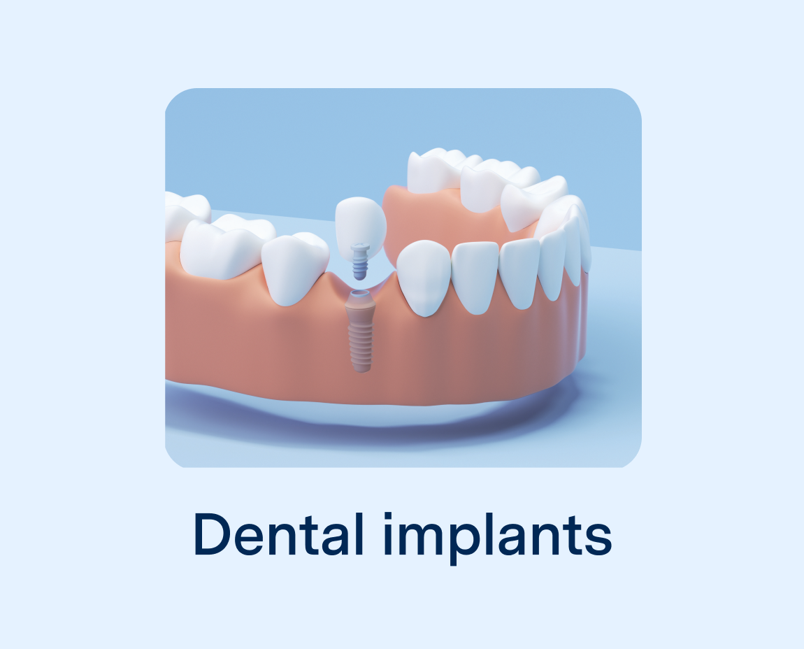 A single dental implant providing a permanent solution for a missing tooth.