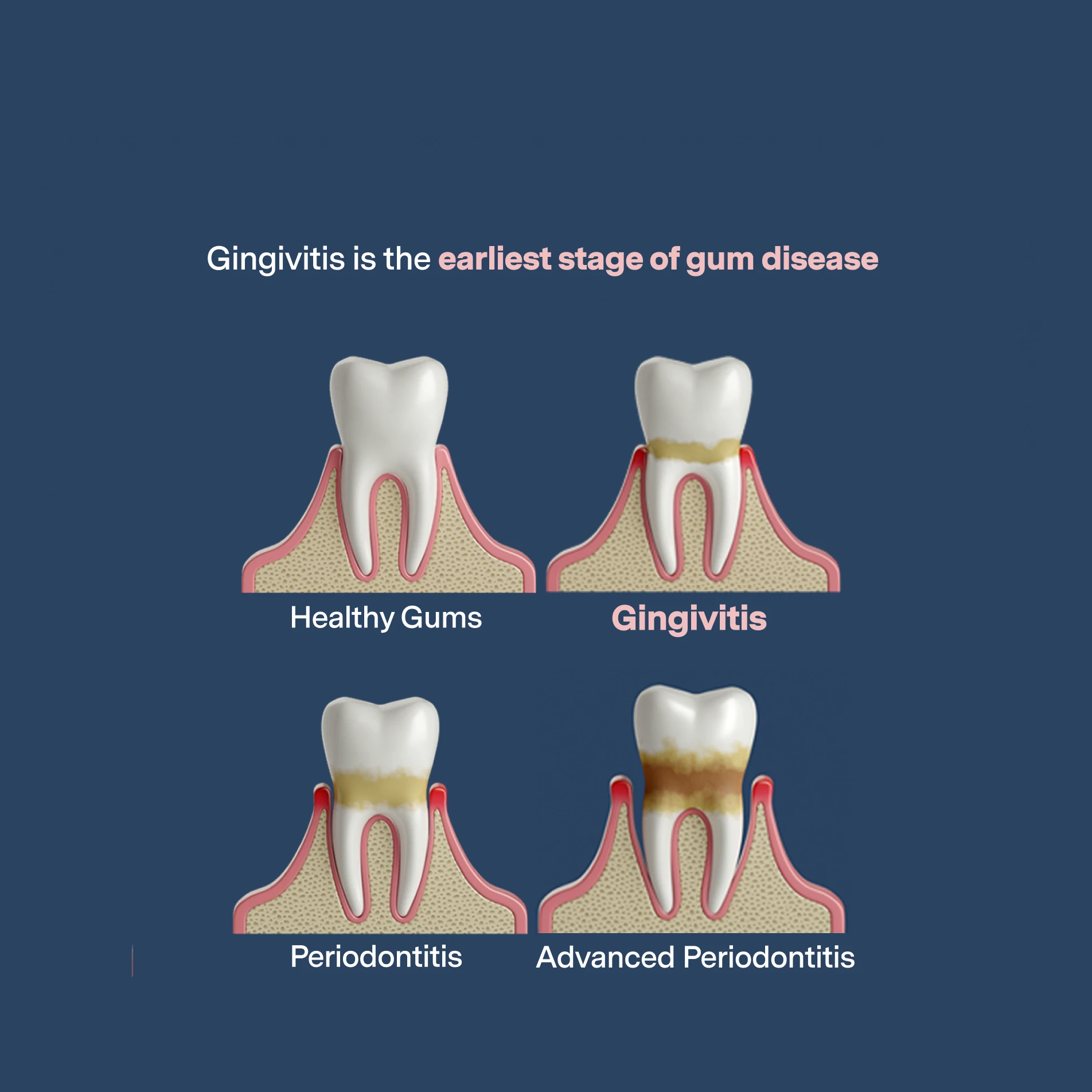 What is gingivitis? Gingivitis is the earliest stage of gum disease. 