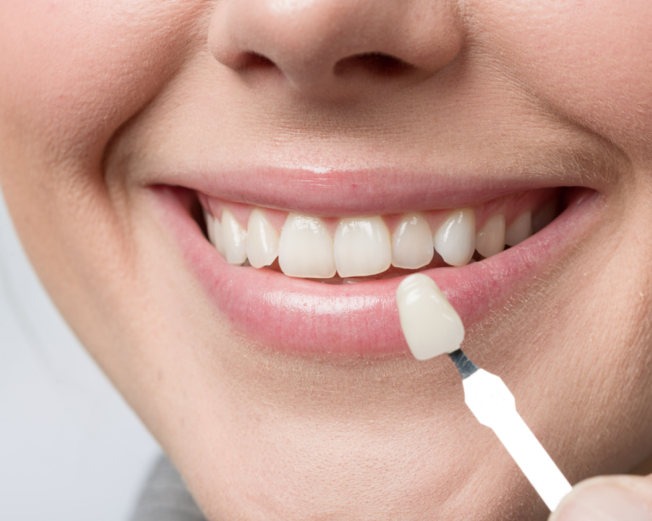 Affordable veneers and financing options at Aspen Dental for restoring teeth.