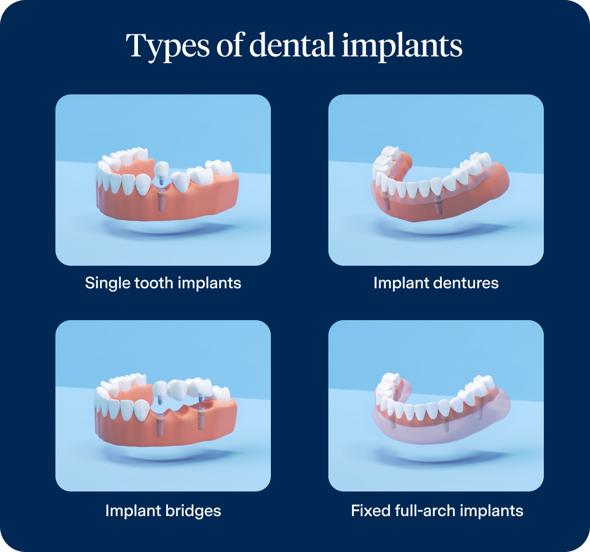 Infographic titled "Types of dental implants" showing four visual examples: single tooth implants, implant dentures, implant bridges, and fixed full-arch implants.