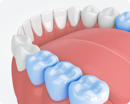 3D illustration of a molar root canal procedure, highlighting the complexity and specialized treatment required for molars due to their foundational role in the bite.
