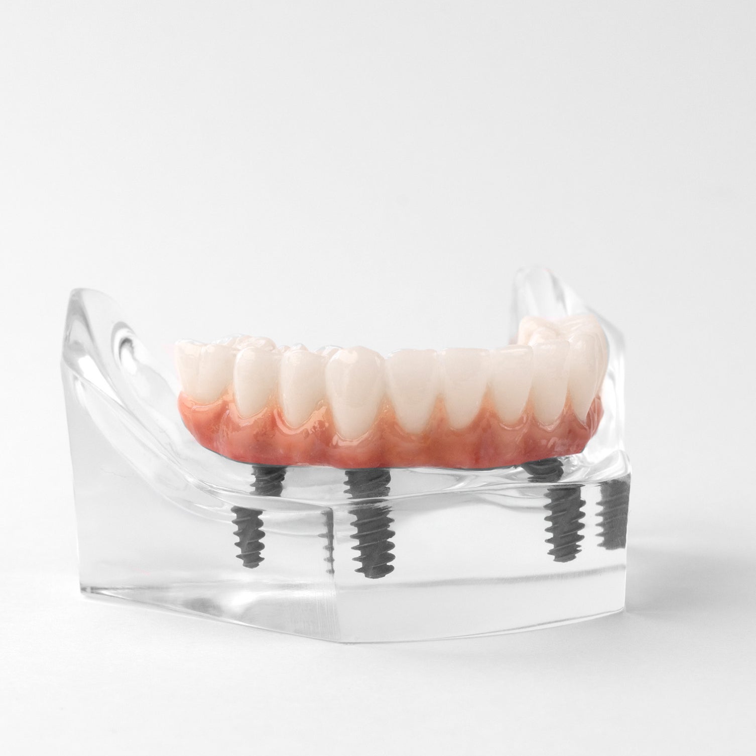A fixed full-arch dental implant model showcasing secure placement with multiple implant posts. This advanced dental solution offers a strong foundation for a new smile, ensuring stability and functionality.