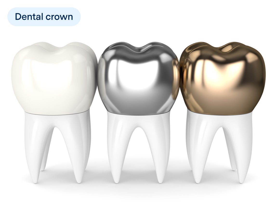 llustration of two teeth showing different types of dental fillings, one with a white composite filling and the other with a silver amalgam filling, labeled with "Dental filling" in a dental treatment context.