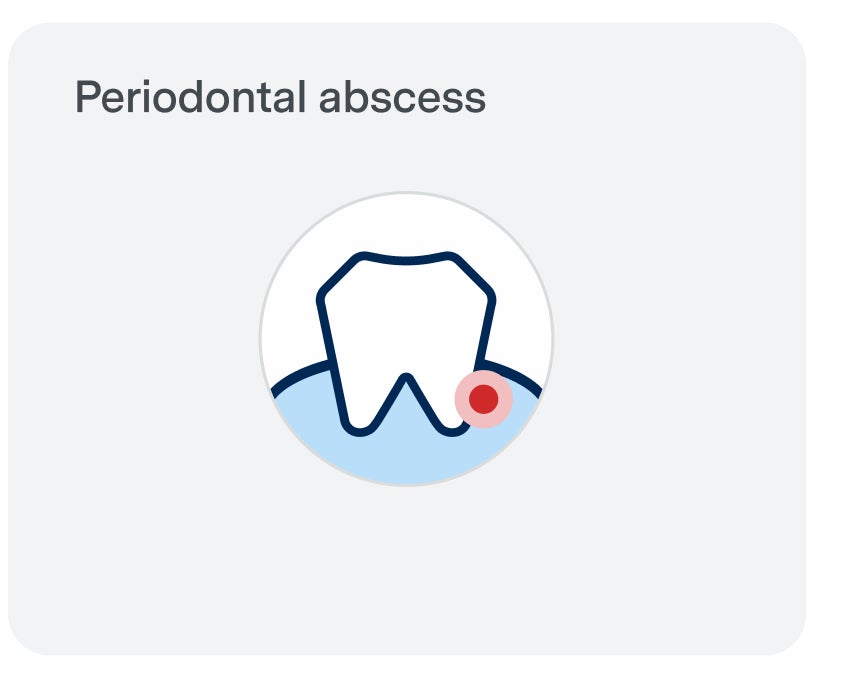 Illustration of a tooth with a red dot at the gum line, representing a periodontal abscess, accompanied by the text "Periodontal abscess."