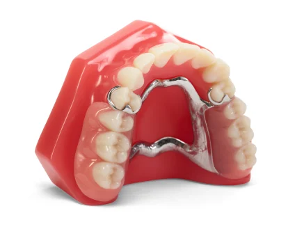 An upper denture model displaying Cast Partial dentures with a metal framework.