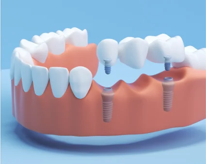 An illustration of a dental implant bridge showcasing a dental bridge with implants on either side to replace partial dentures with long-lasting solution.