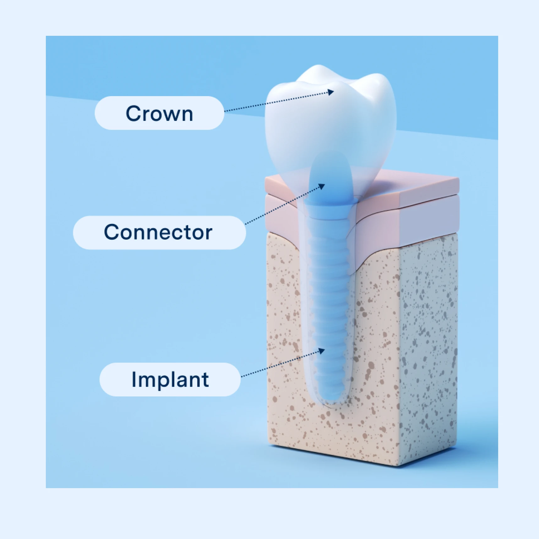 3D diagram of dental implant parts with labels Crown, Connector, Implant on a jaw cross-section against blue.