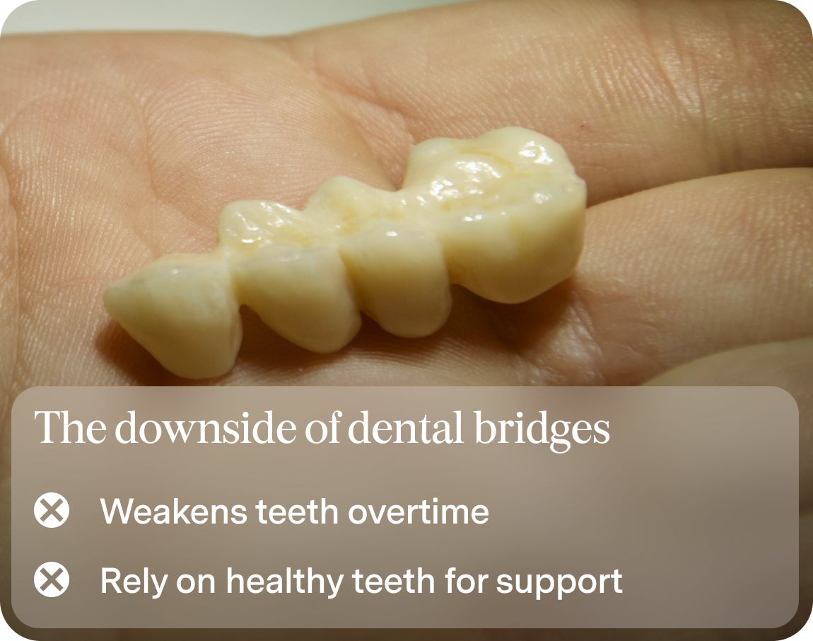 An image of a dental bridge, along with text describing some of its downsides, including weakening teeth overtime and reliance on healthy teeth for support.