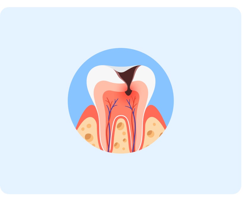 Illustration of a tooth with infection in the dental pulp, displayed in a circular frame with light blue background.