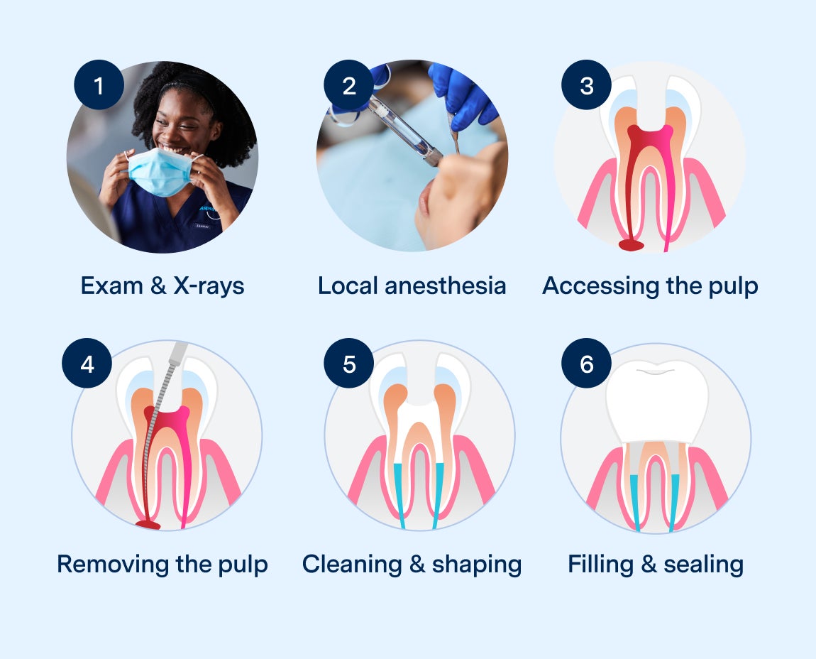 Aspen Dental illustration showing the six steps of a root canal procedure: Exam & X-rays, local anesthesia, accessing the pulp, removing the pulp, cleaning and shaping, and filling and sealing. The steps are depicted with images of a dentist, dental tools, and cross-sections of a tooth during the procedure.