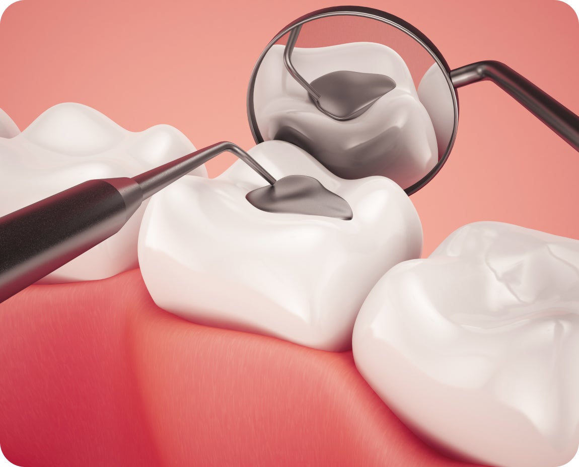 Dental mirror shows a silver amalgam filling on a molar, demonstrating how the restoration seals and supports decayed teeth.