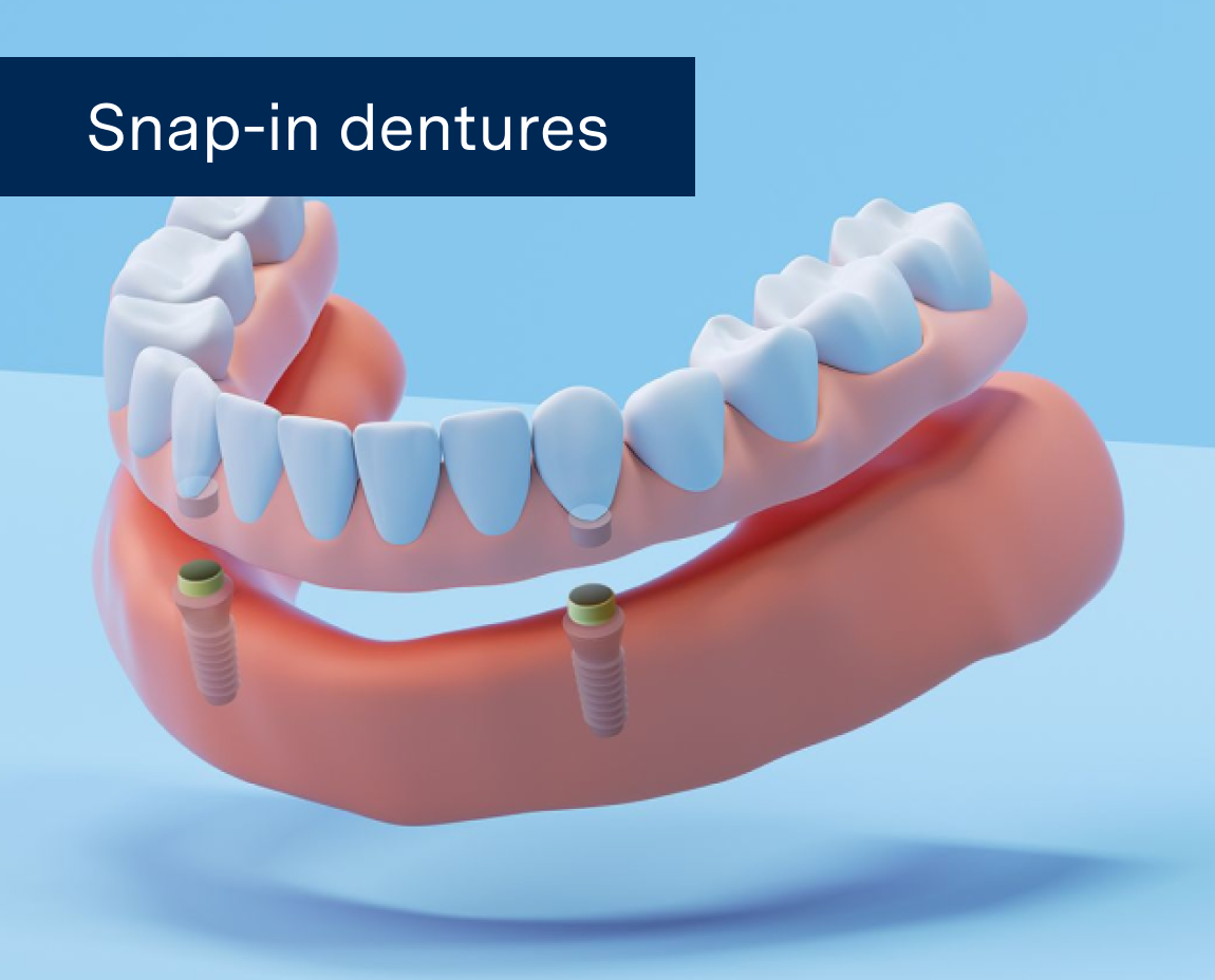 A graphic of an implant denture (snap-in dentures) on a blue background with the words "Snap-in Dentures" written on the image.