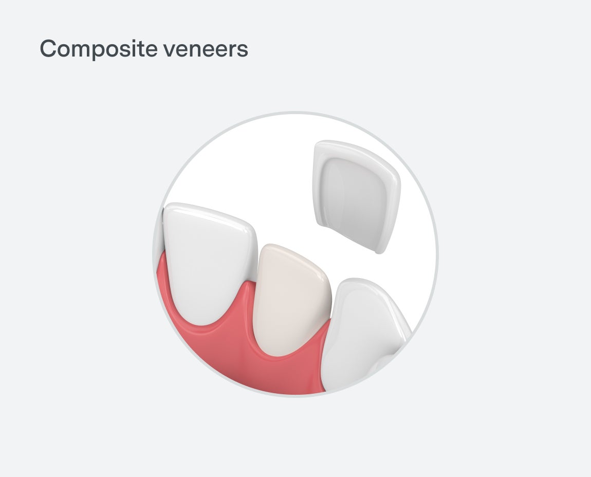 Illustration showing the application of composite veneers to teeth. One veneer is partially detached, demonstrating how it covers the natural tooth. The image is labeled "Composite veneers.