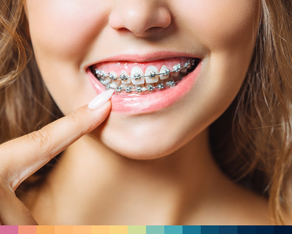 Close-up of a smiling woman pointing to her dental braces on her teeth.