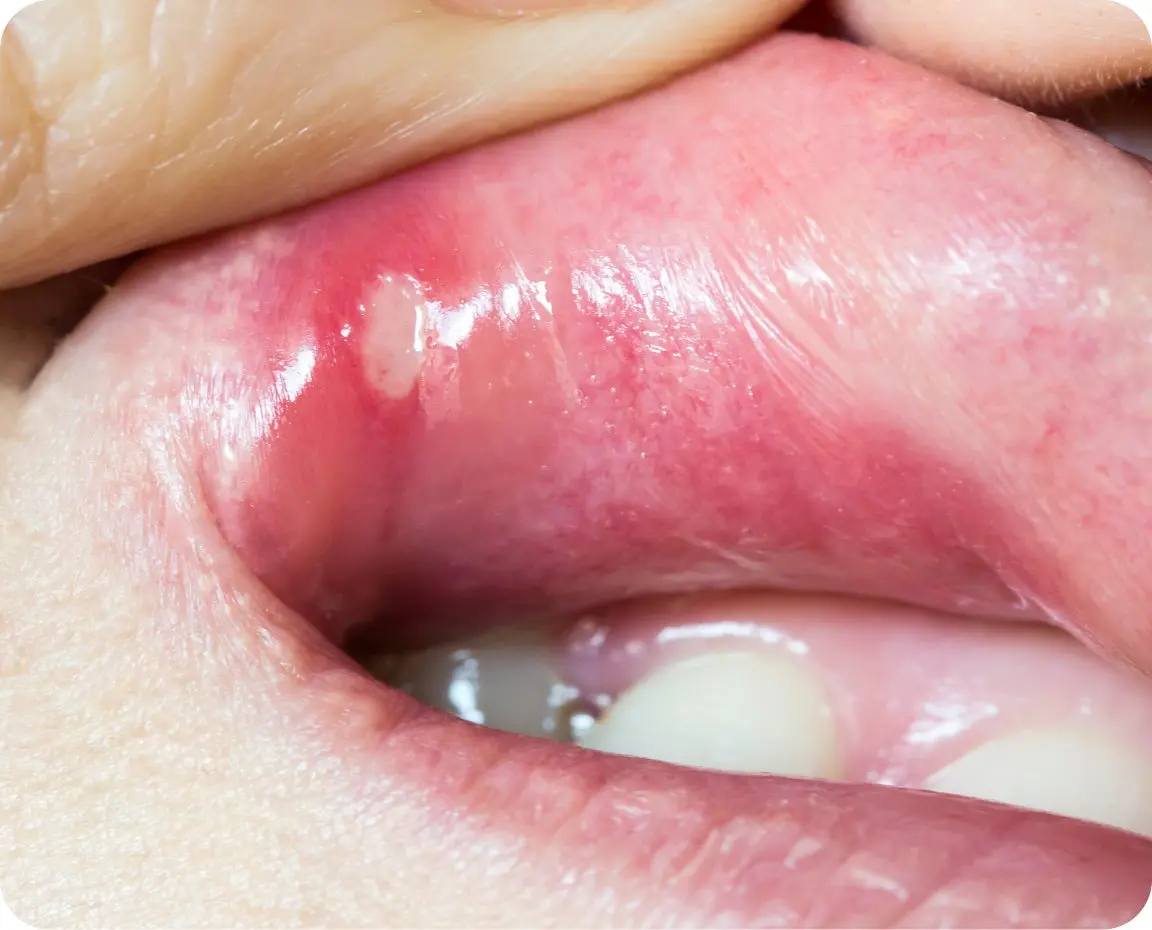 A visible sore inside the bottom lip, with surrounding redness and swelling, used to highlight the appearance of a canker sore in contrast to cold sores.