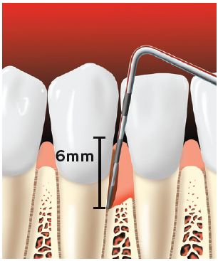 Aspen Dental Probe Disease Image