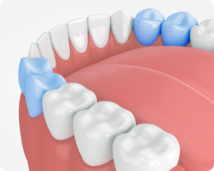 3D illustration of a premolar root canal procedure, focusing on the bicuspids, which involve more intensive treatment due to their positioning and anatomy.