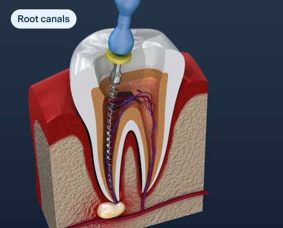 Detailed illustration of a root canal procedure, showing the removal of damaged pulp from the tooth.