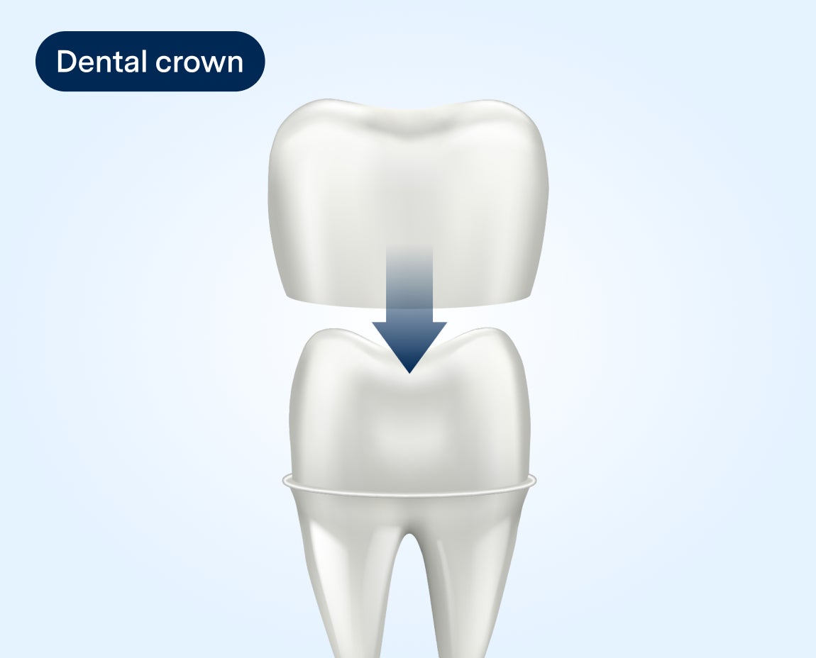 Diagram showing a dental crown being placed on top of a tooth, with an arrow indicating the position of the crown, demonstrating the dental restoration process.