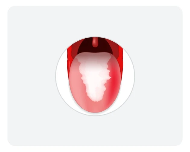 An illustration of a tongue with creamy-white coating, as well as a red hue to the right side, indicative of an infection, such as oral thrush.