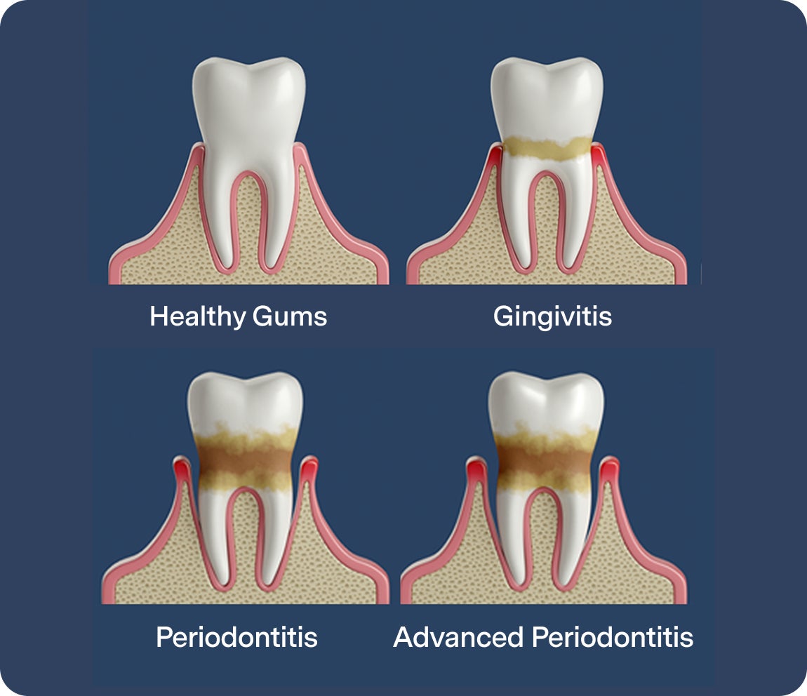 An image showing the different stages of a tooth from having healthy gums, to gingivitis, to periodontitis, and eventually advanced periodontitis.