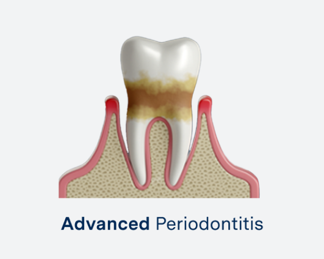 Illustration of a tooth affected by advanced periodontitis, showing severe gum recession, bone loss, and buildup of plaque and tartar. The condition is labeled "Advanced Periodontitis."