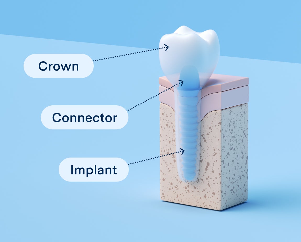 Diagram showing a dental implant structure, labeled with three parts: the crown at the top, the connector in the middle, and the implant at the bottom embedded in a block.