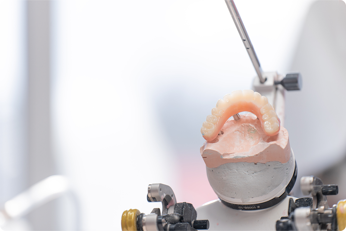 implant-supported full arch dental prosthesis mounted on a dental articulator in a lab, showing implant denture fabrication and precise fitting for tooth replacement