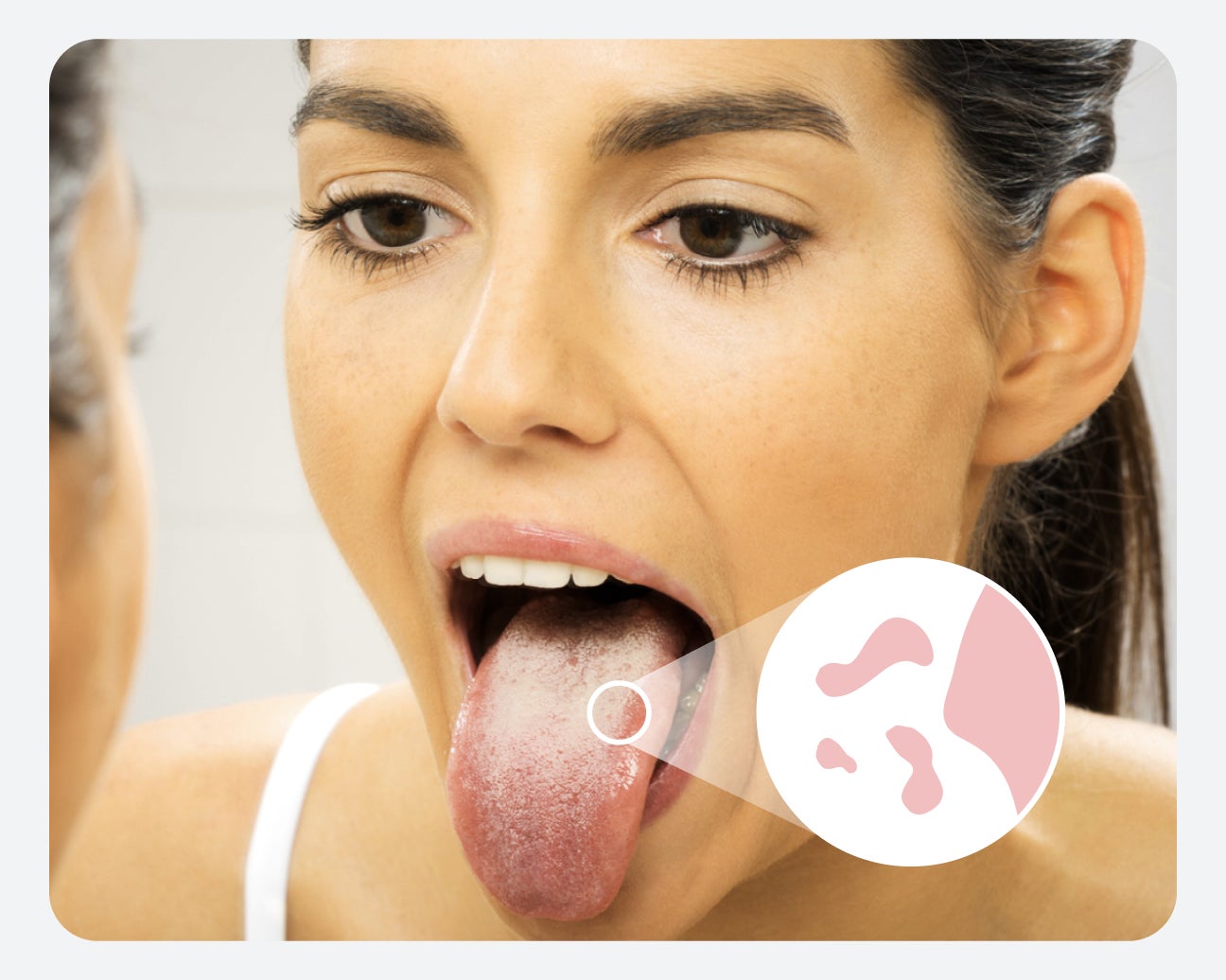 A person looking in a mirror with a close-up of their tongue showing a magnified area with white patches.