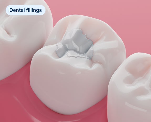 Close-up illustration of a tooth with a dental filling, demonstrating the process of restoring a tooth damaged by decay.