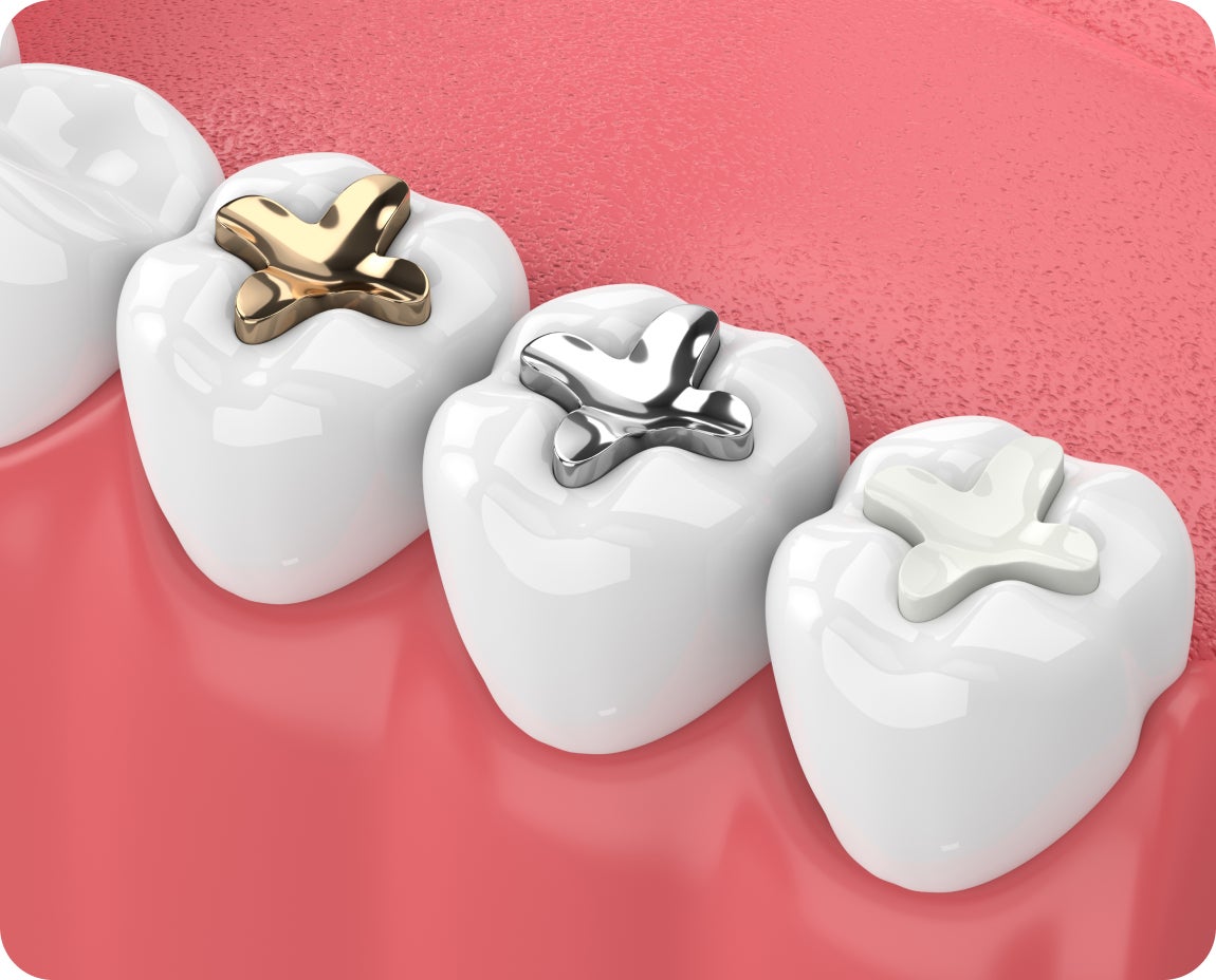 Three molars side-by-side showing gold, silver amalgam, and composite fillings to compare common dental restoration materials for tooth decay.