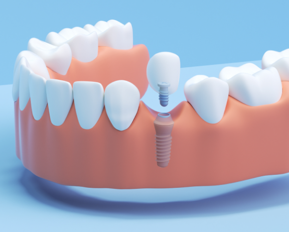 An illustration of a dental implant with a tooth and an implant, showcasing a permanent solution for missing teeth.