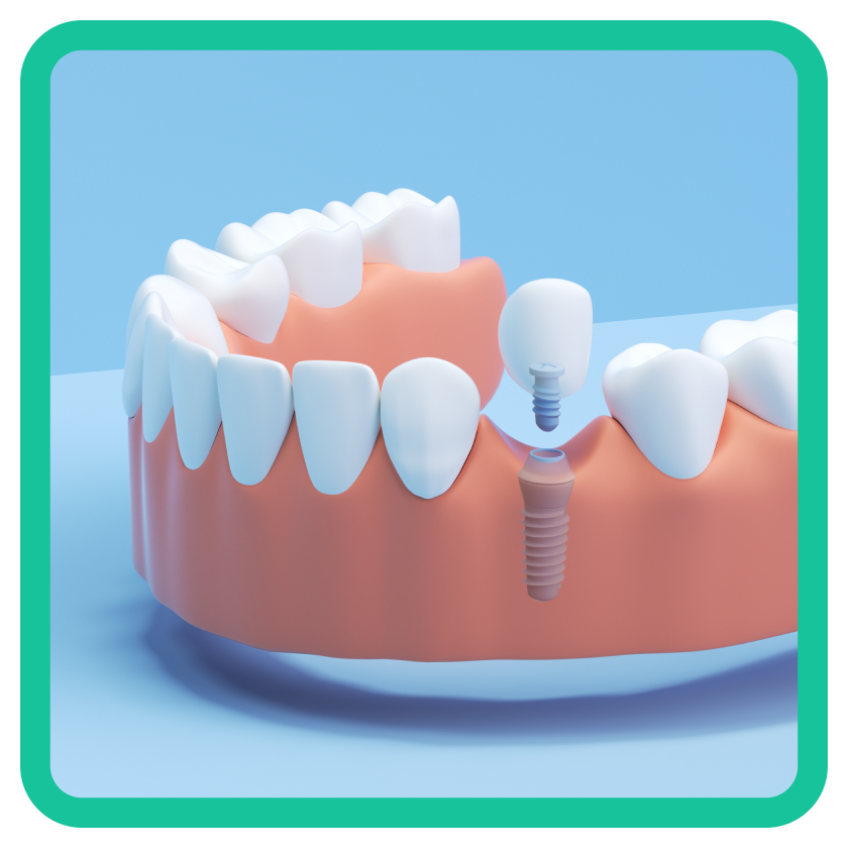Un gráfico que muestra un implante dental de un solo diente, demostrando cómo este se encuentra en la fila inferior.