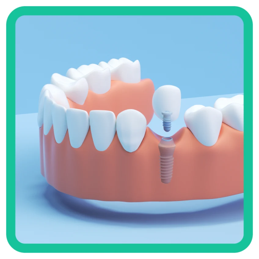 Un gráfico que muestra un implante dental de un solo diente, demostrando cómo este se encuentra en la fila inferior.