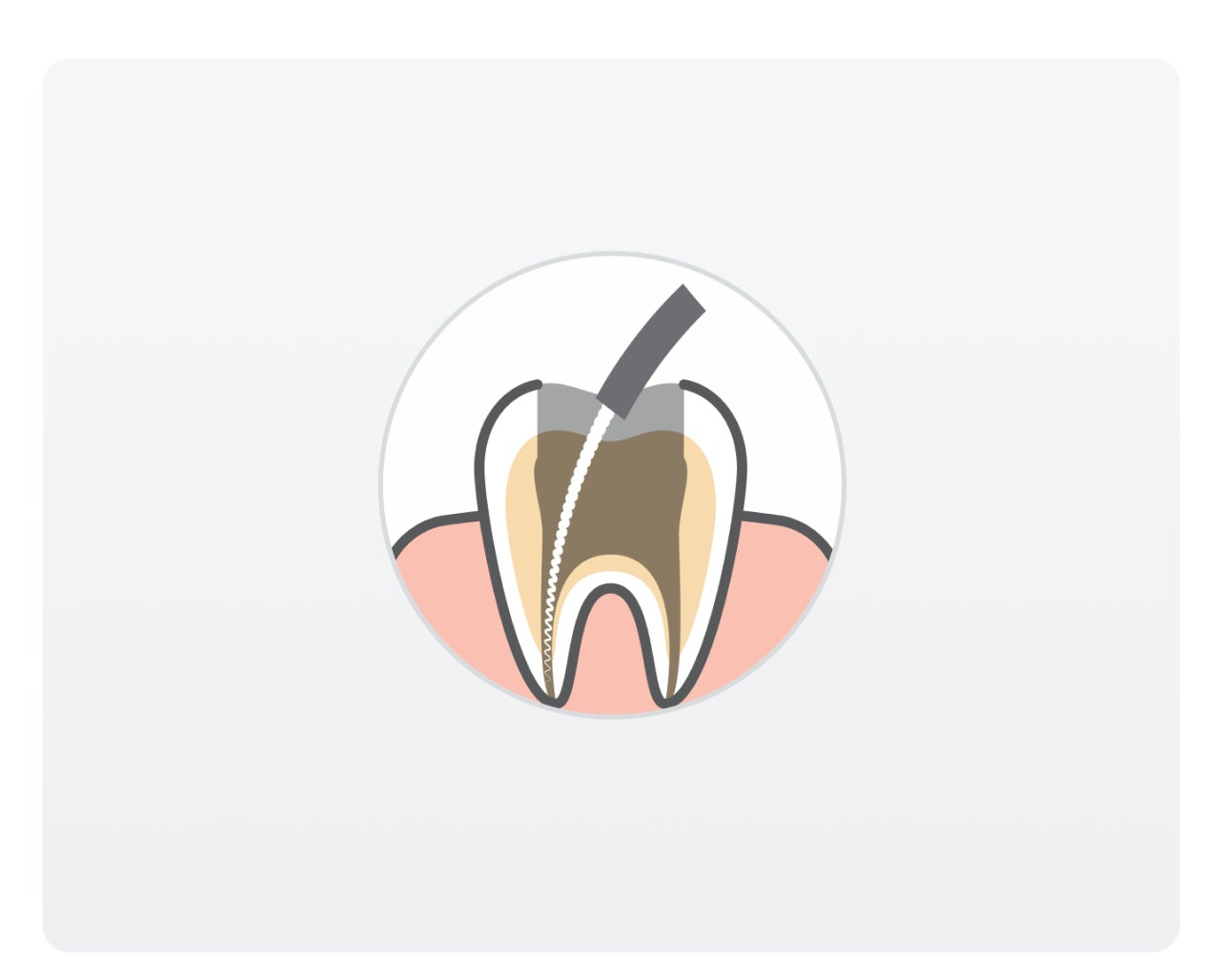  Illustration of a tooth cross-section showing a root canal procedure, with a dental instrument cleaning the inside of the tooth.