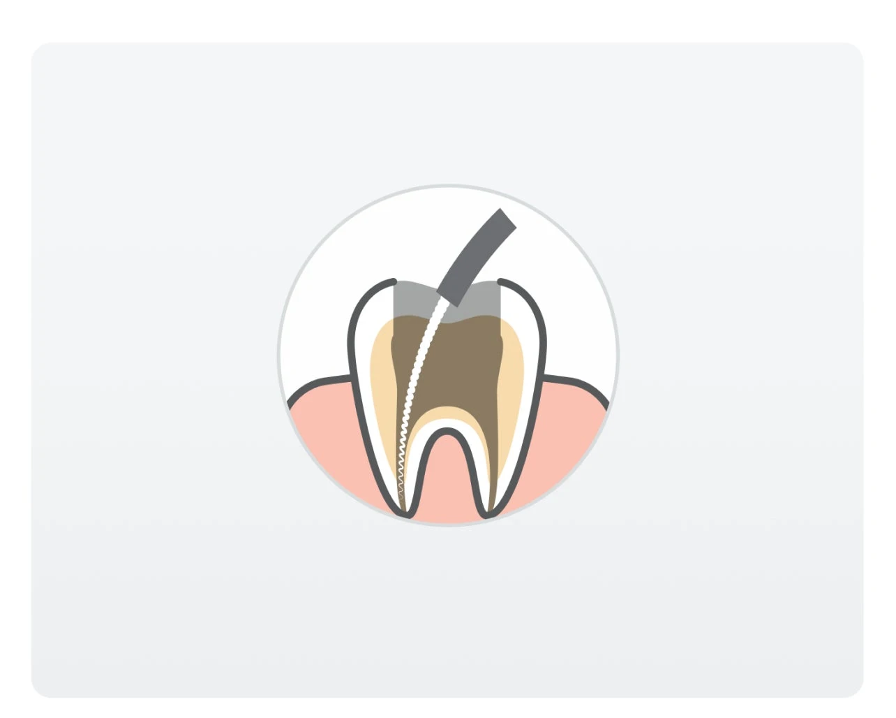 Illustration of a tooth cross-section showing a root canal procedure, with a dental instrument cleaning the inside of the tooth.