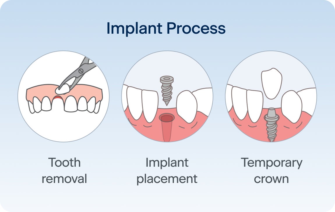 An image showing the three steps of a one day dental implant process, tooth removal, implant placement, and temporary crown placement.