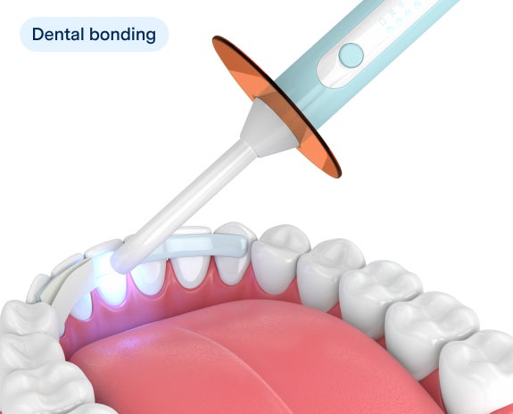 Illustration of a dental bonding procedure, showing the application of tooth-colored resin to a tooth using a dental tool. This process is minimally invasive and is used to correct minor chips.